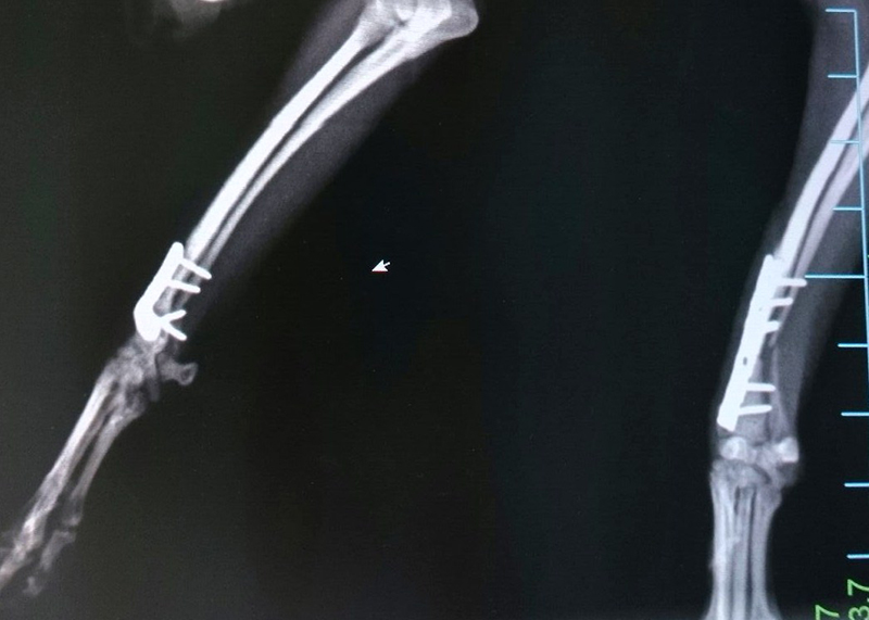 橈尺骨骨折（両側）　骨折整復手術（両側）