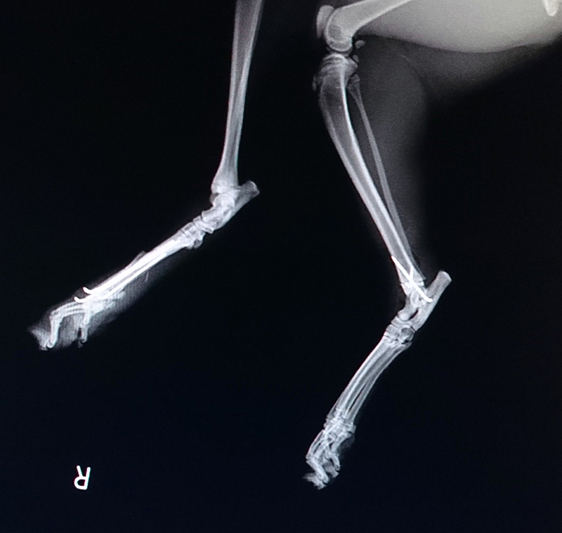 中足骨骨折4箇所（右側）遠位脛骨骨端板骨折（左側）